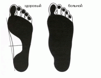 Остальные виды спорта: Плоскостопие и бег