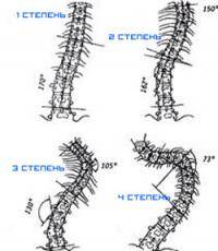 Остальные виды спорта: Сколиоз первой степени
