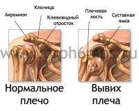 Остальные виды спорта: Растяжение связок плеча