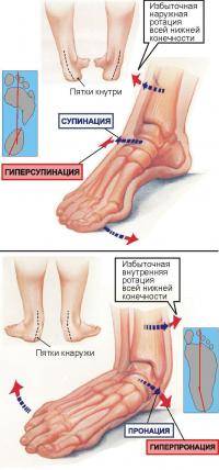 Легкая атлетика: Что такое пронация и как определить какая она