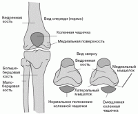 Легкая атлетика: Хруст в колене  чашечка стреляет  У кого то такое было