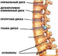 Фитнес и бодибилдинг: травма позвоночника как быть дальше