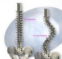 Фитнес и бодибилдинг: Сколиоз или искривление позвоночника